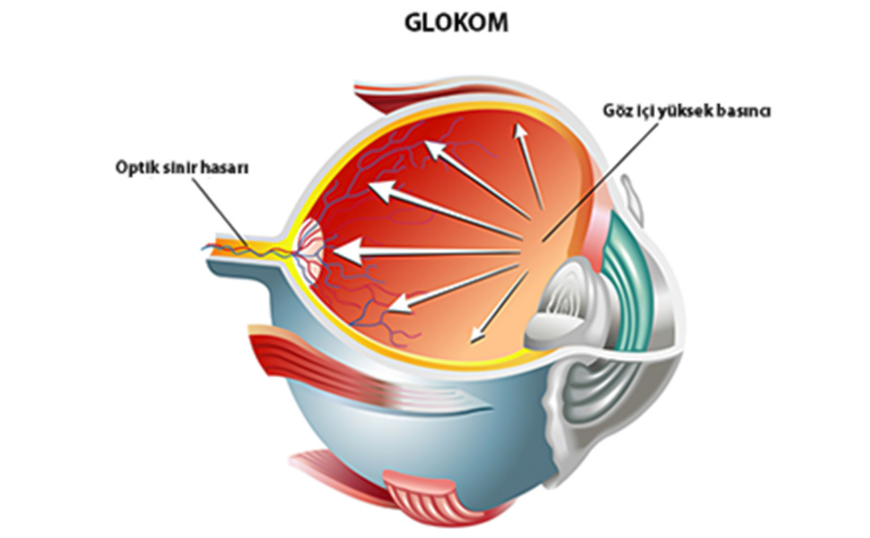 Glokom Kimlerde Görülür? - Gaziantep Göz Hastalıkları Uzmanı Kliniği - Prof. Dr. Şeyhmus ARI