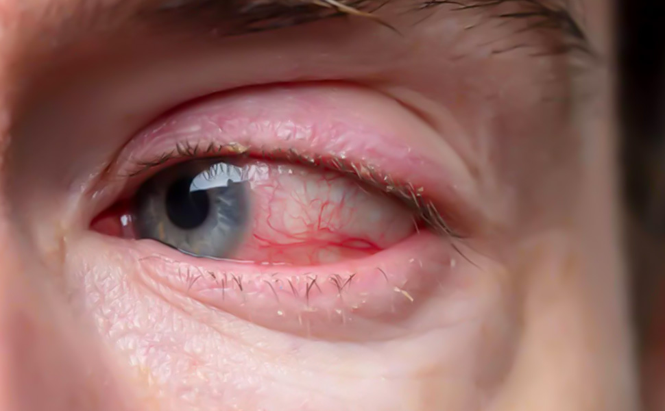 Retina Dekolmanı ve Retina Yırtılması - Prof. Dr. Şeyhmus ARI - Gaziantep Göz Hastalıkları Uzmanı