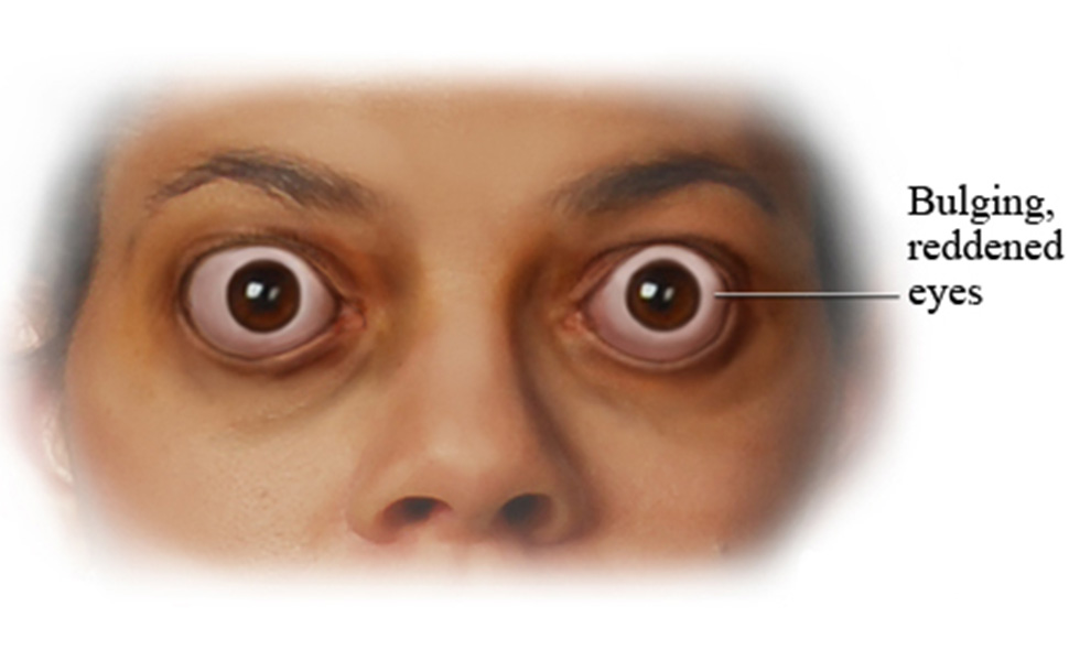 Tiroide Bağlı Göz Hastalıkları - Gaziantep Göz Hastalıkları Uzmanı Kliniği - Prof. Dr. Şeyhmus ARI